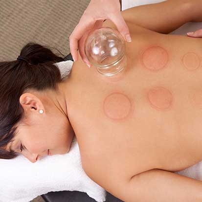 RC Walk-In Chiropractic | Cupping Massage Therapy